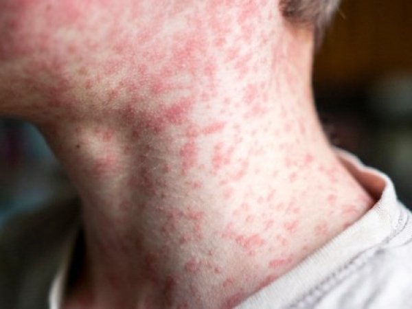 Sarampión: autoridades alertan por síntomas y refuerzan la vacunación